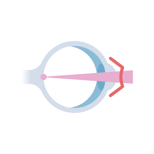 Ortho-k and Myopia Control
